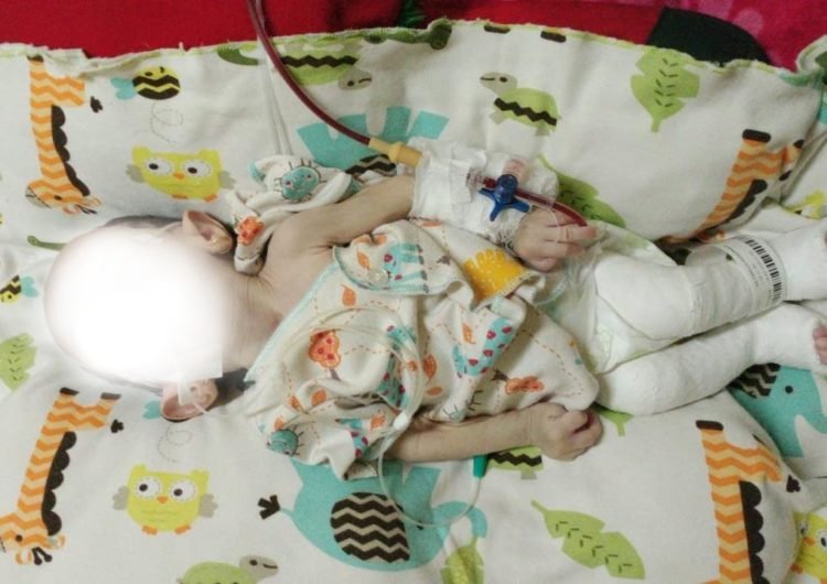 Tim Shalokal Ajak Dermawan Membantu Shilla Bayi 8 Bulan Penderita Hydrocephalus