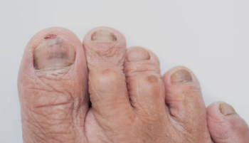 Kenapa Kuku Kaki Bisa Menghitam?